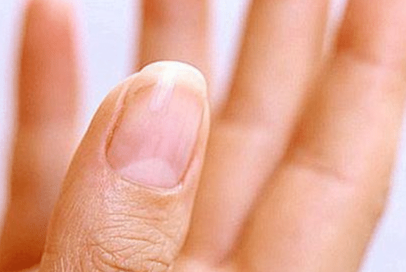 指甲出现5种异常表现,预示着肾衰竭的降临!请高度关注!