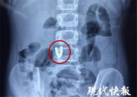 磁铁吞下去了怎么办=如果磁铁不小心吞进肚子里怎么办?