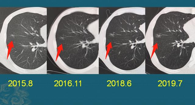 肺纤维灶是什么意思?会长成肺癌吗?该怎么办更安全?