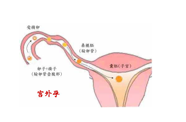 为什么现在"宫外孕"如此频繁?这3个原因,女人需好好反思一下