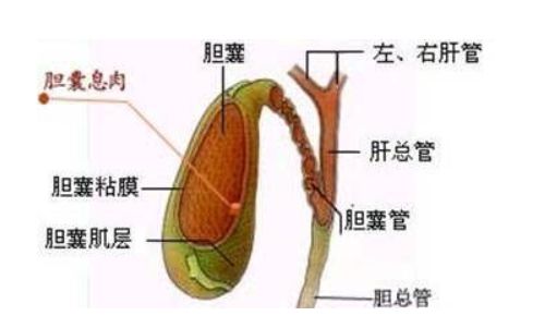 发现胆囊息肉怎么办?