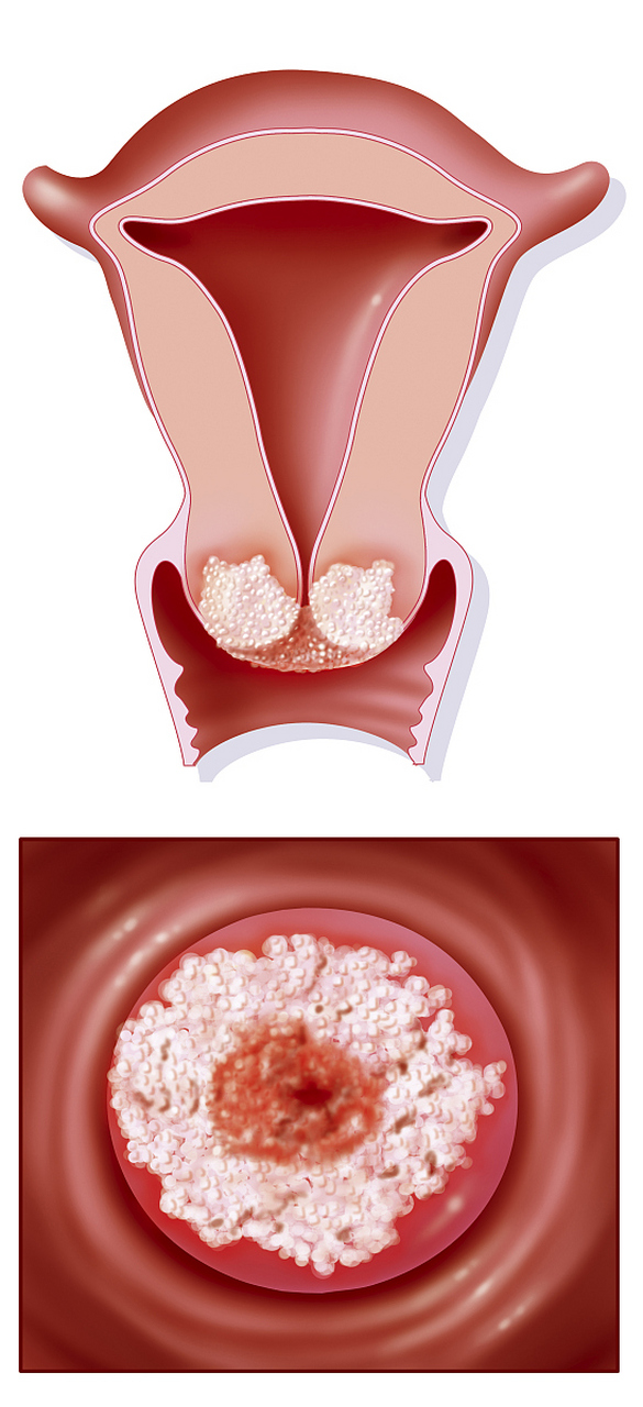 宫颈息肉图片 清晰图片