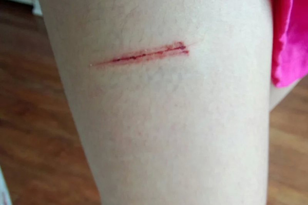 皮肤被划伤,就要打破伤风针吗?在什么情况下,一定要打?