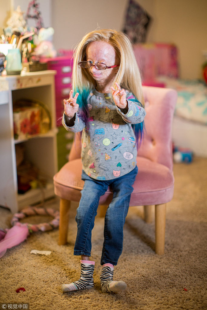美国早衰症女孩红爆网络 拍搞笑视频点击量破亿