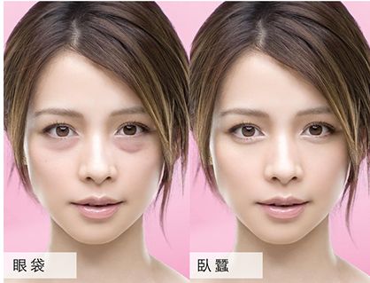 泪沟是怎么形成的?该怎样消除?