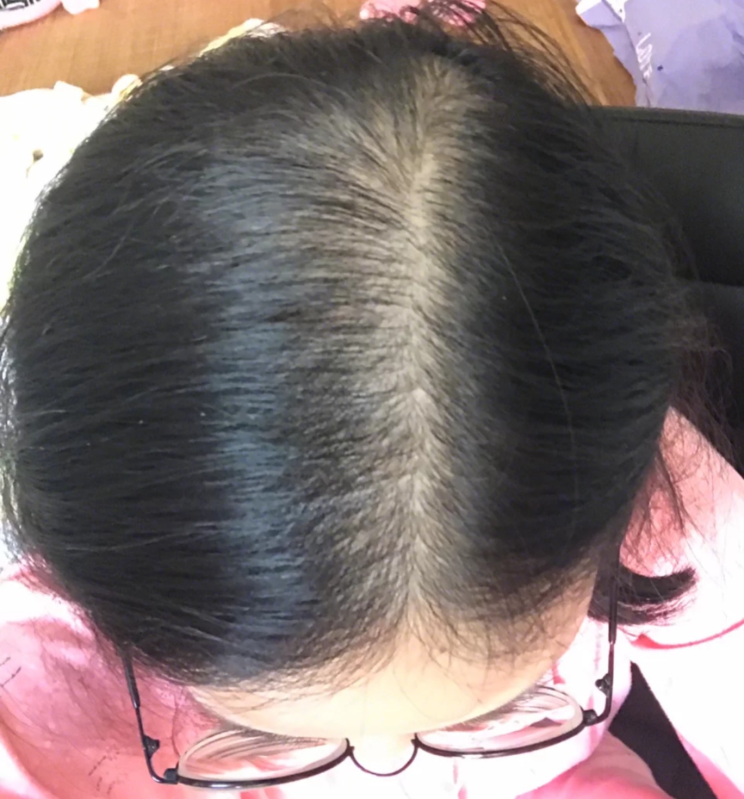 头发太爱出油给人感觉很邋遢?试试这样做不用每天洗头也很清爽