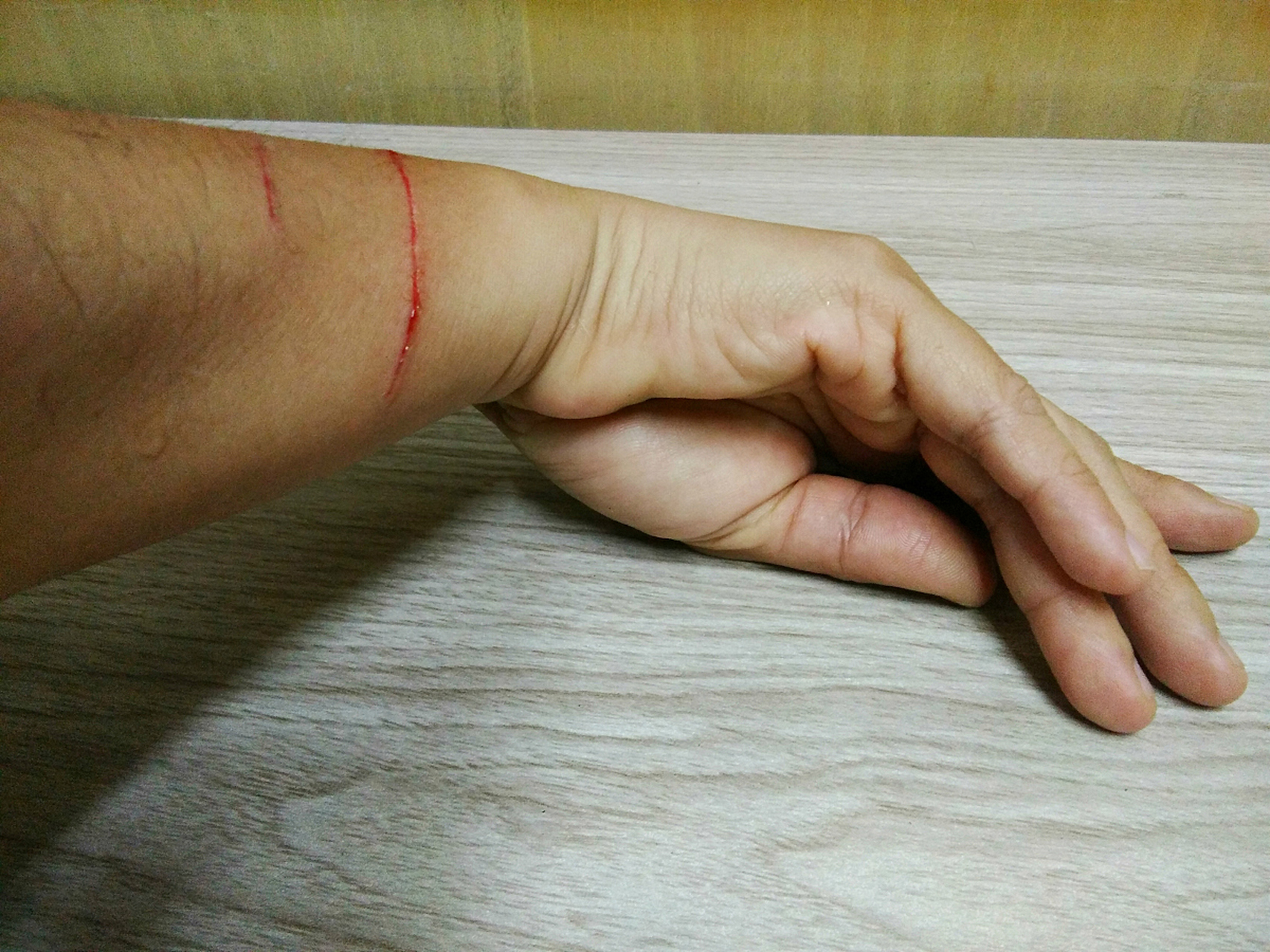 我的侄子因为没有完成作业,被老师用木条打了手心.