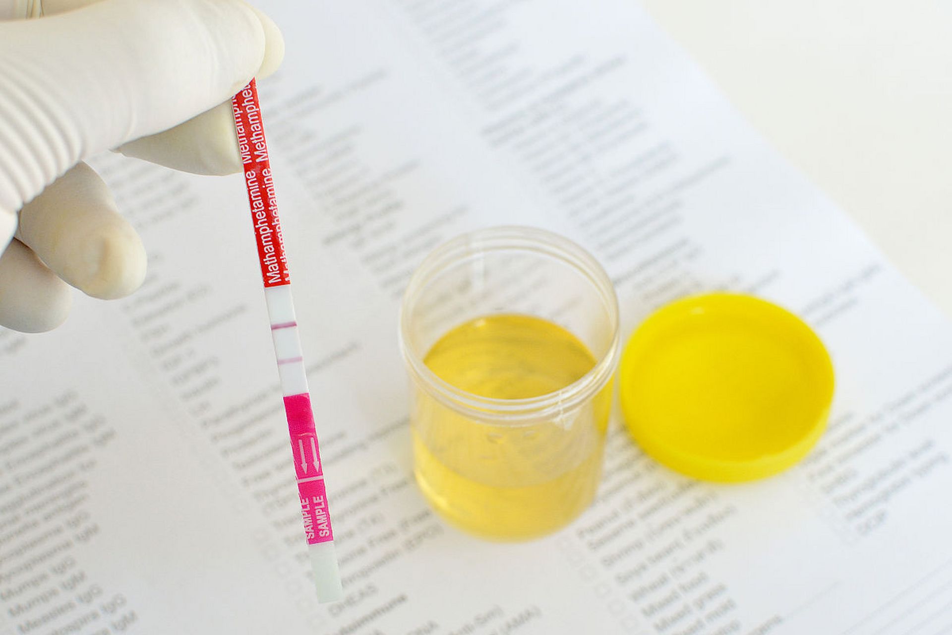 尿蛋白有时有有时无怎么办?