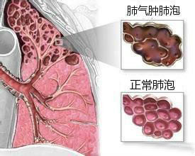 肺气肿是什么引起的图片