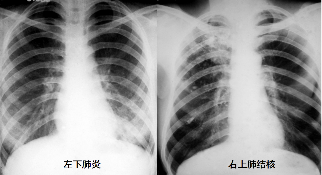 新冠肺炎片子图片