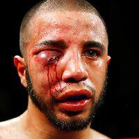 最可怕的拳击受伤!这位拳手被打成外星人,他更是被打出两个脑袋