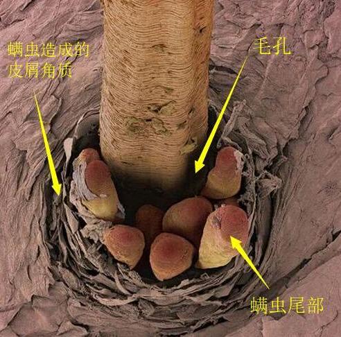 脸上这3个信号不注意,毛囊螨越来越多,皮肤慢慢变"发财橘"状