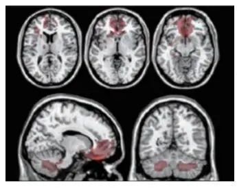 揭开「现代医学高科技之冠」PET/CT 的神秘面纱