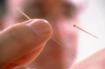 【每日医穴】周楣声老中医:治疗7种病症的简易针灸疗法!