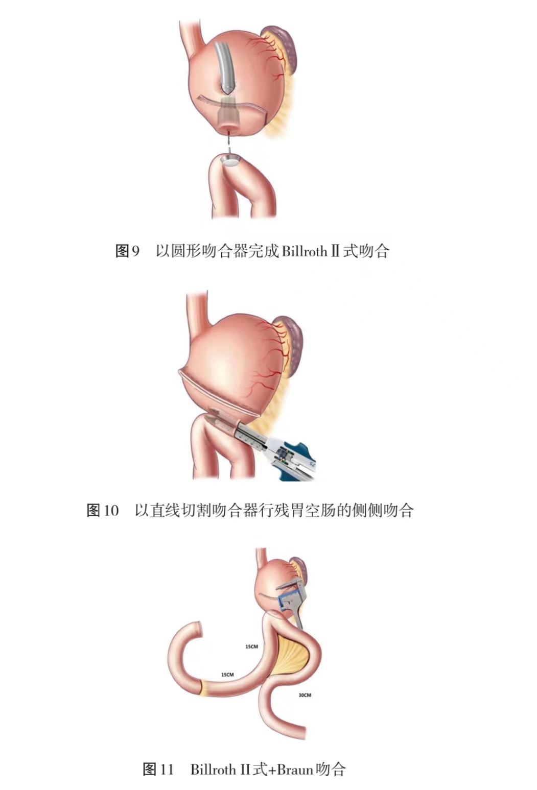 吻合器使用方法图解图片