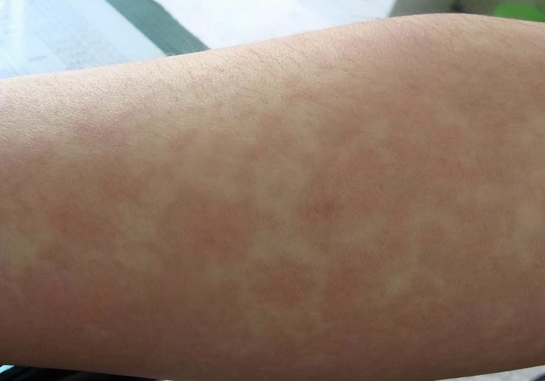 男子被晒晒伤,皮肤晒得通红,也不想撑伞,主要原因是觉得撑伞很丢人啊