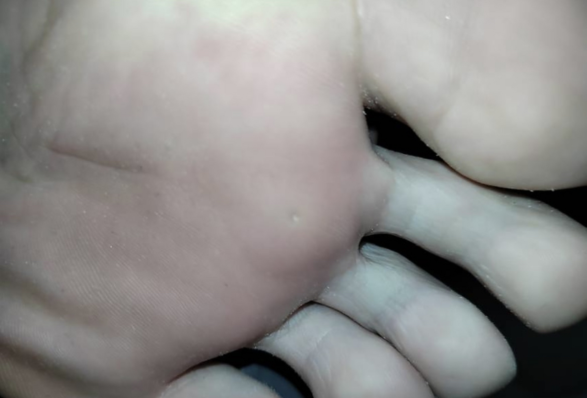 健康# 脚上长鸡眼该如何治疗?