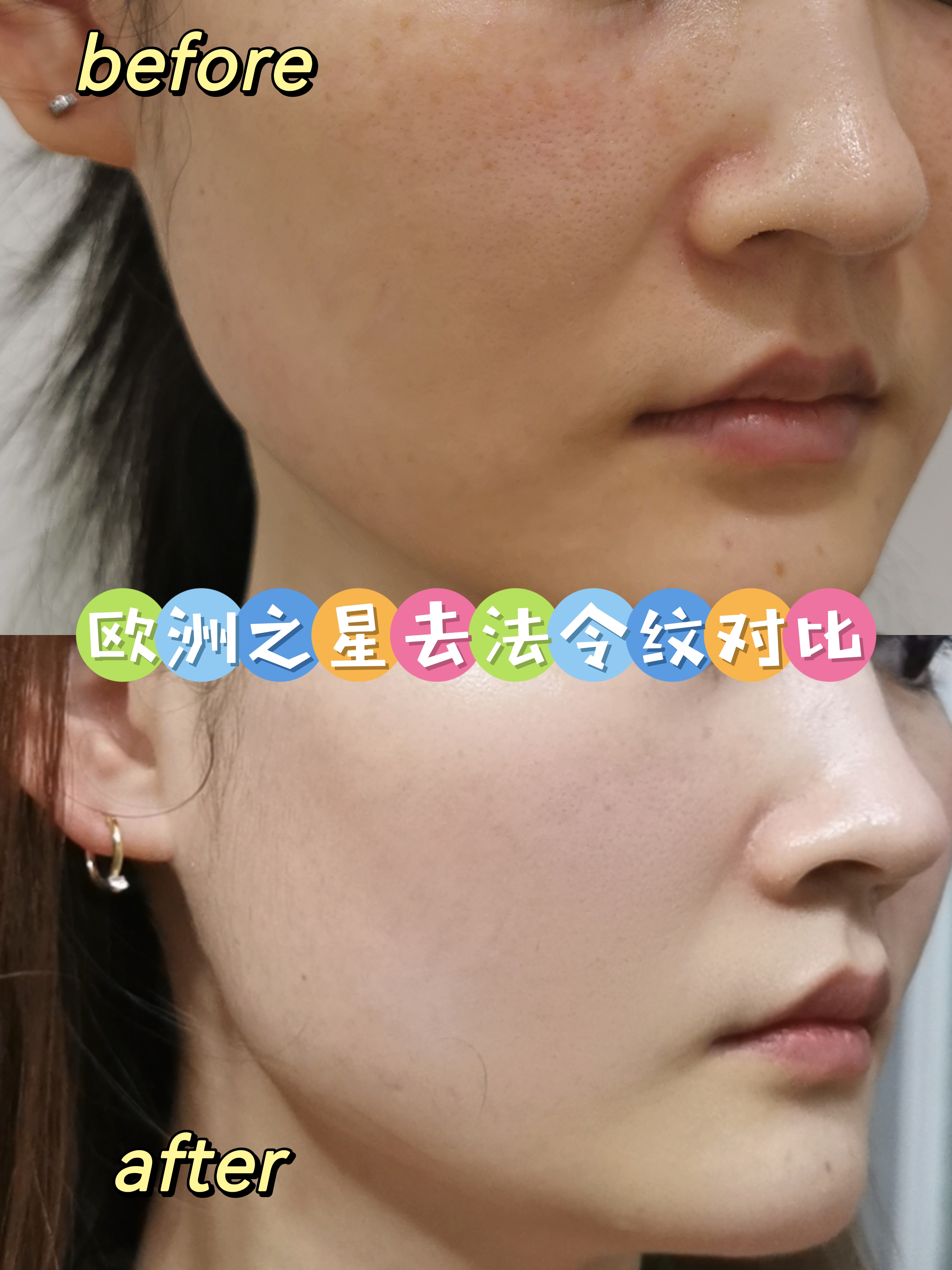 欧洲之星fotona