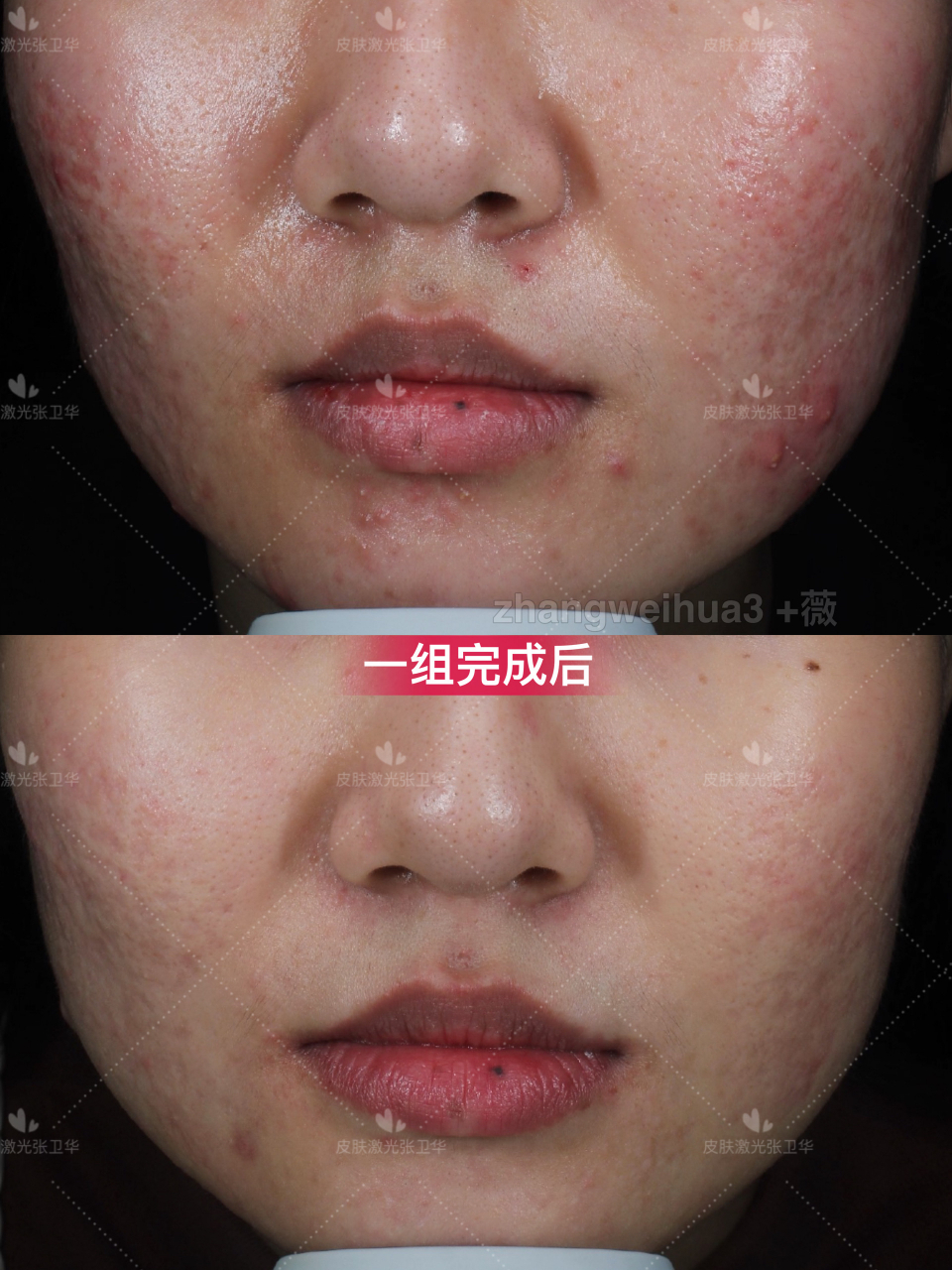 【严重痘坑77敏感修复一组后visia 对比】  这孩子之前在别的地方