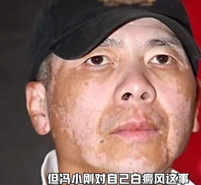 冯小刚17年白癜风病症消失!脸上光溜模样变化大,自曝原因惹人羡