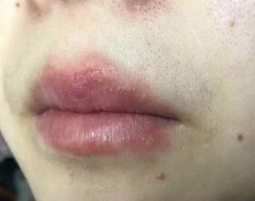 唇周干燥瘙痒是怎么回事?