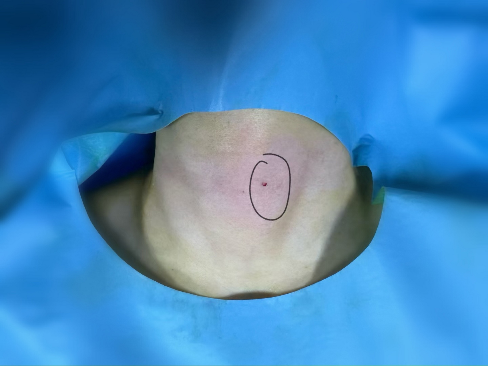 甲状腺结节消融