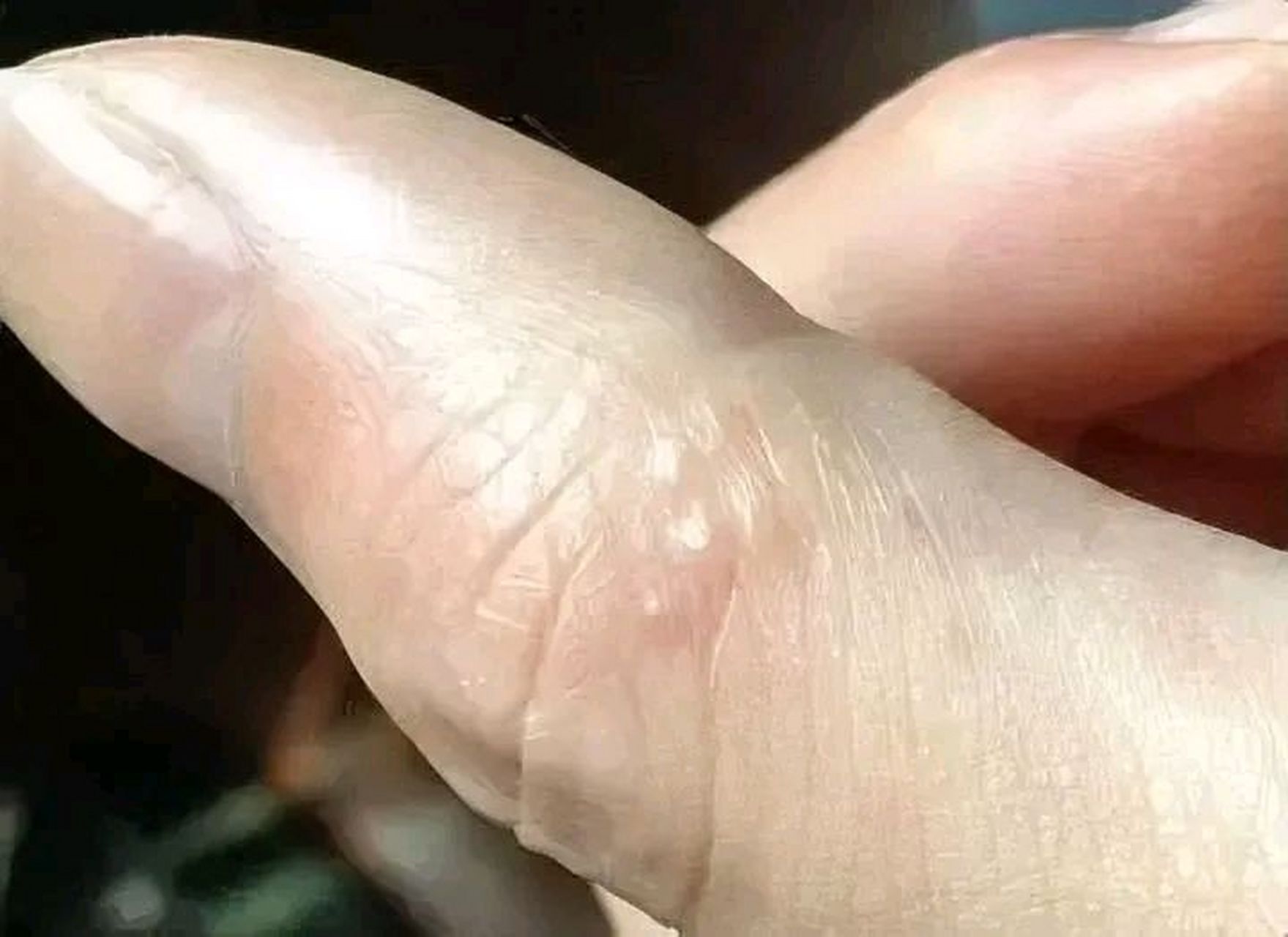 手上起小水泡可能是湿疹的表现之一,但不能仅凭这一症状就断定为湿疹.