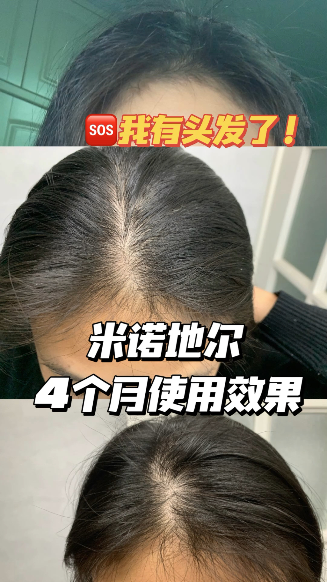 米诺地尔搽剂使用感受到四个月效果反馈妈妈我有头发啦