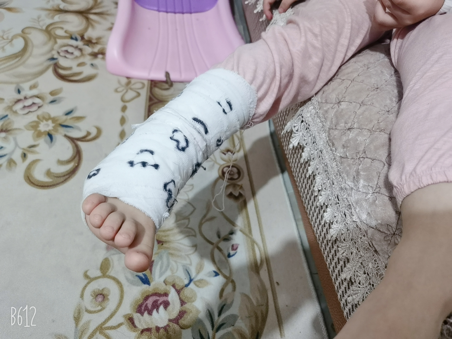 小朋友真是活力四射,一大早在房间里的太欢乐,把脚崴了