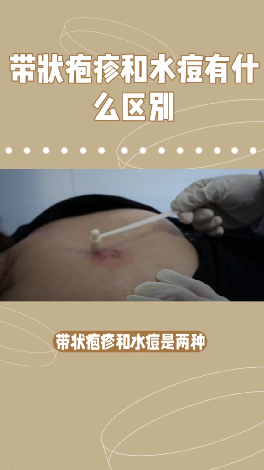 带状疱疹和水痘有什么区别呢?又该如何处理呢?