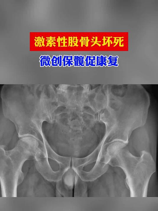 激素性股骨头坏死 微创保髋促康复