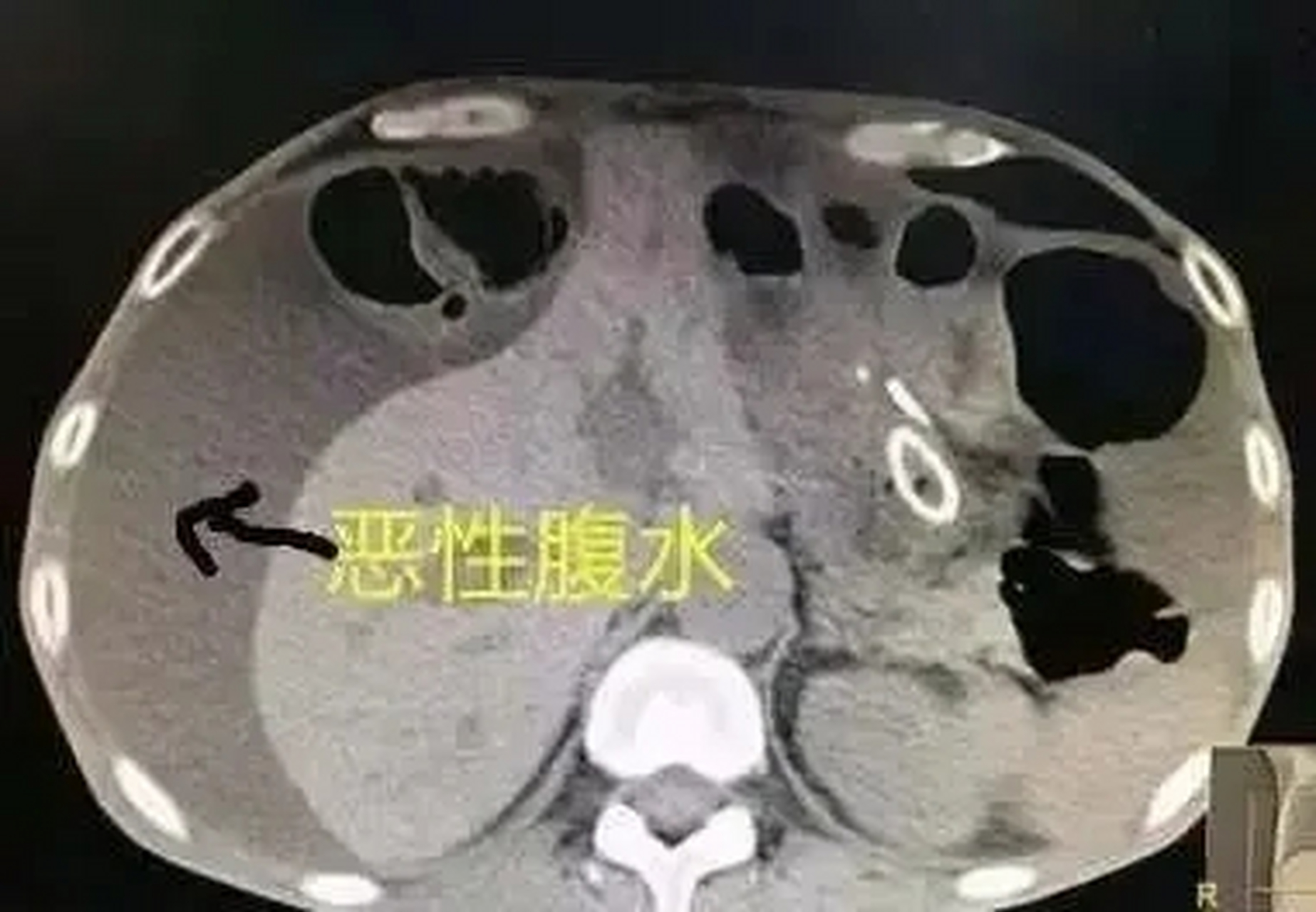 癌症肿瘤患者腹水,生命进入倒计时?如何消肿利水,中医重用一味药!