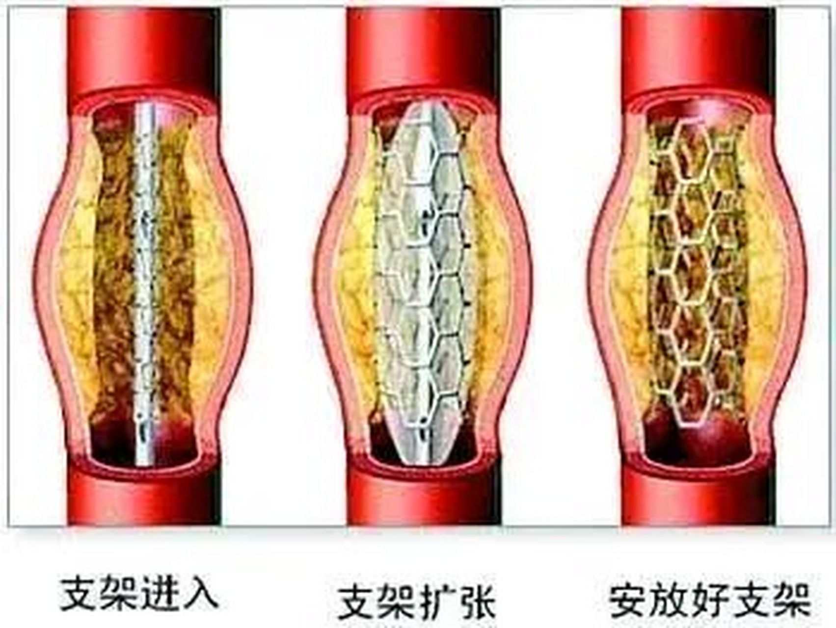 美敦力冠脉支架图片