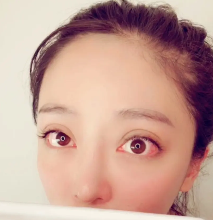 吸雕双眼皮手术有哪些优势?要选择适合自己的双眼皮手术