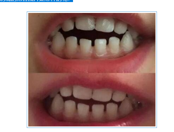 吃安抚奶嘴有什么危害,长期使用安抚奶嘴的危害图片