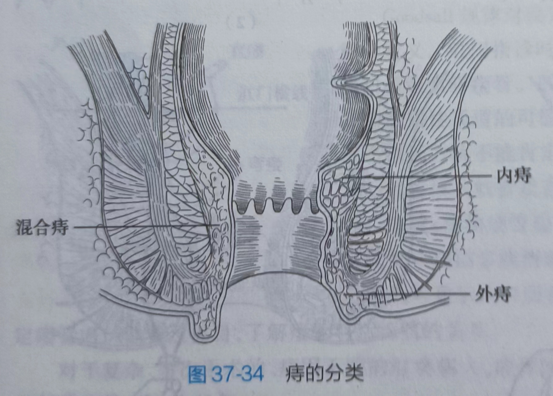 痔疮截石位点钟图解图片