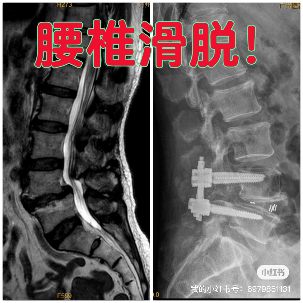 腰椎滑脫,融合手術後,滑脫基本復位了