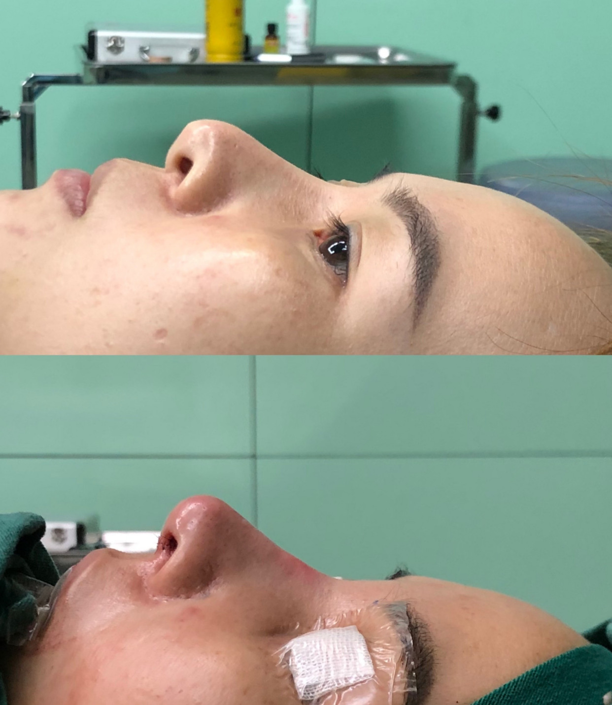 一个修复的鼻子,术前假体快顶穿鼻头
