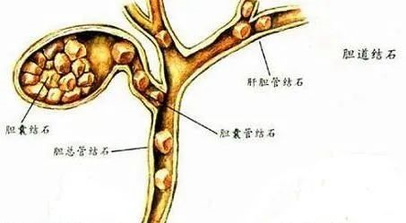 肝外胆管结石,胆总管结石的知识点考点