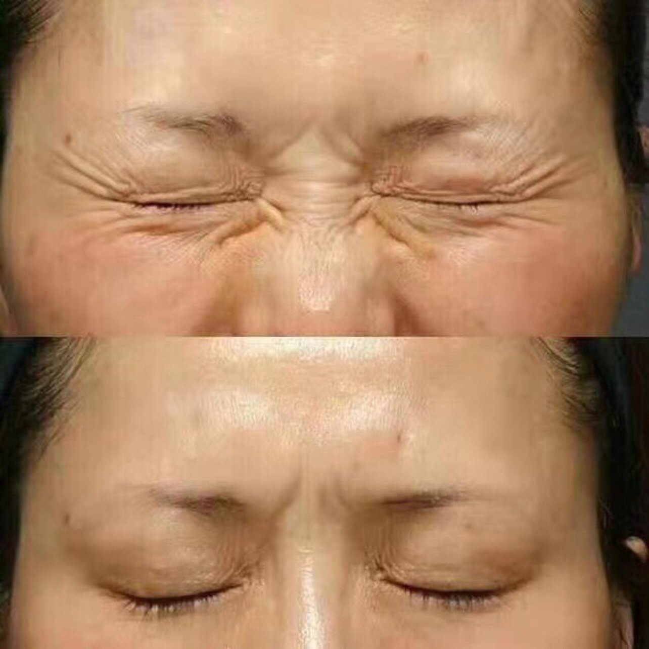 盘点女明星偏爱的热门医美项目,看看她们是如何悄悄变美的