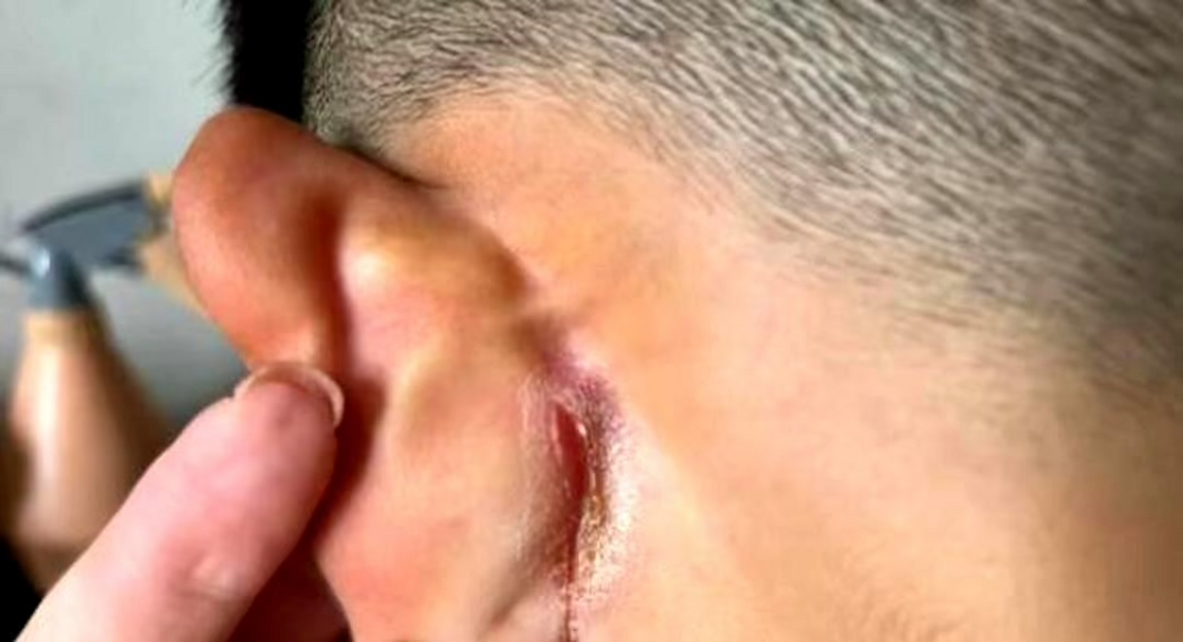 这也不是冬天耳朵怎么会冻烂?怎么回事