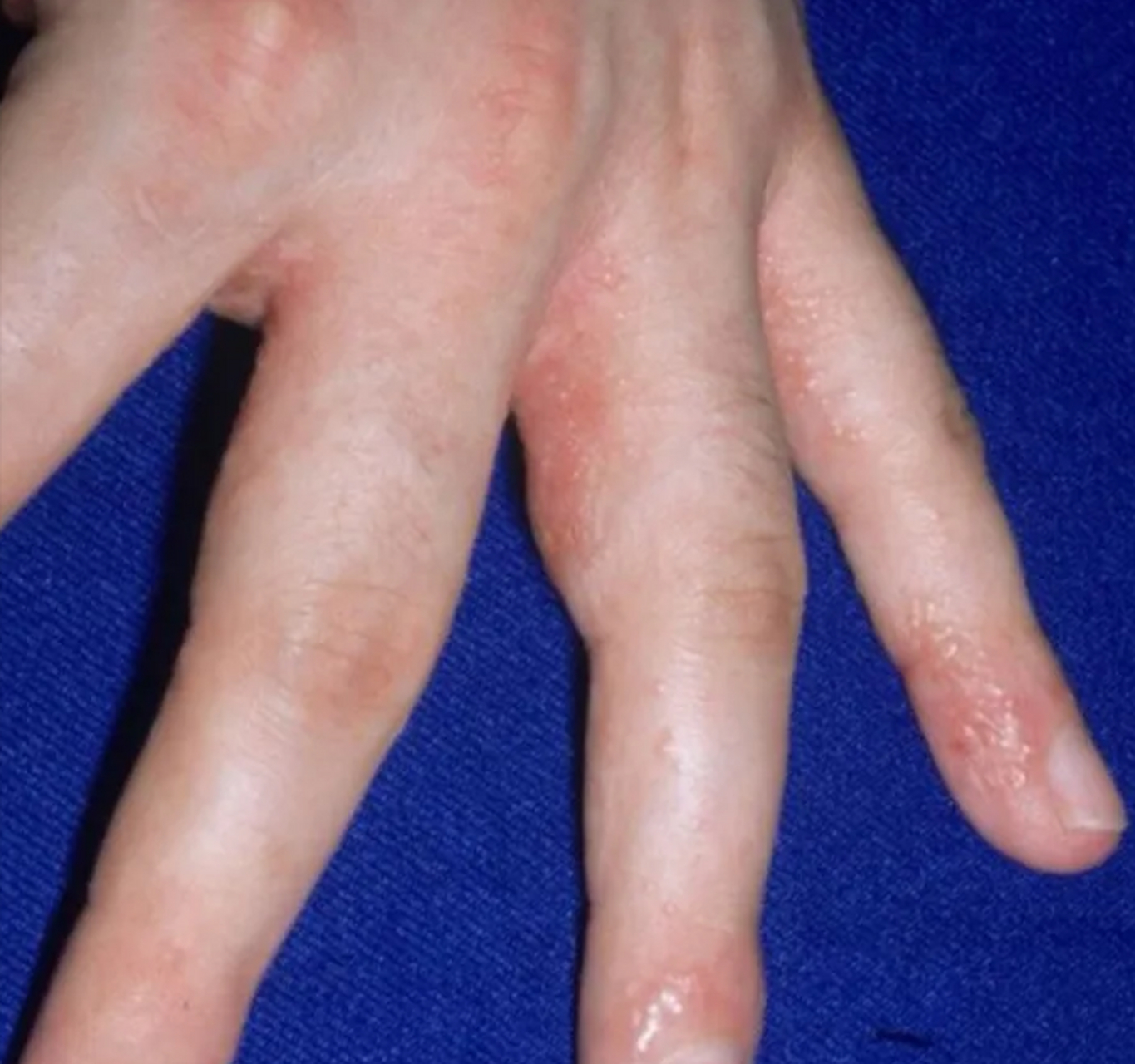 一到夏天,很多人在手指的两侧,会突然长一些密密麻麻的小水泡,而且会