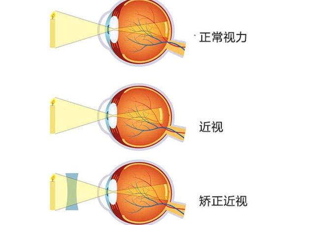 眼睛近视原理图图片