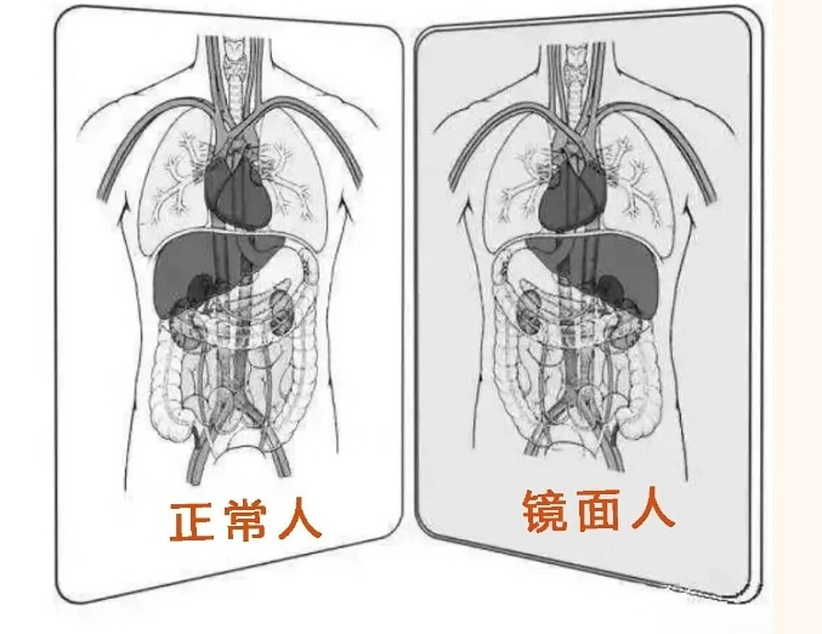 2023年3月27日,宜宾市第一人民医院胃肠外科徐其银博士团队率先完成