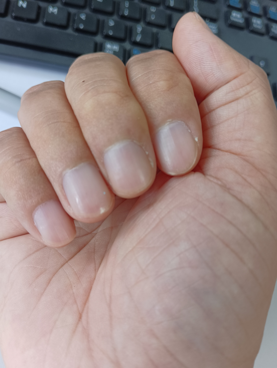 最近无名指指甲变这样,好像涂过指甲油一般闪亮,这是什么情况?