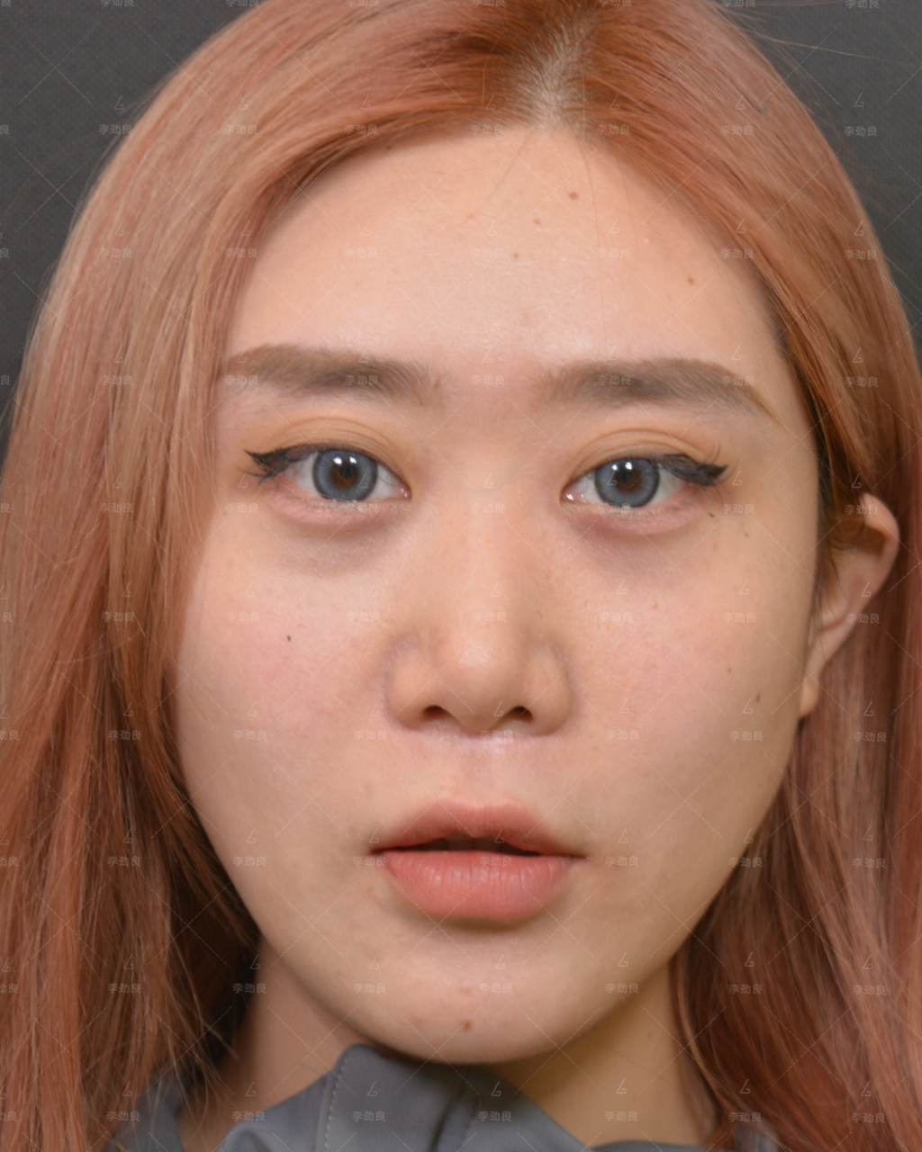 姑娘术前最大的问题就是面中部凹,型コ,正面看脸很平,毫无立体感,显