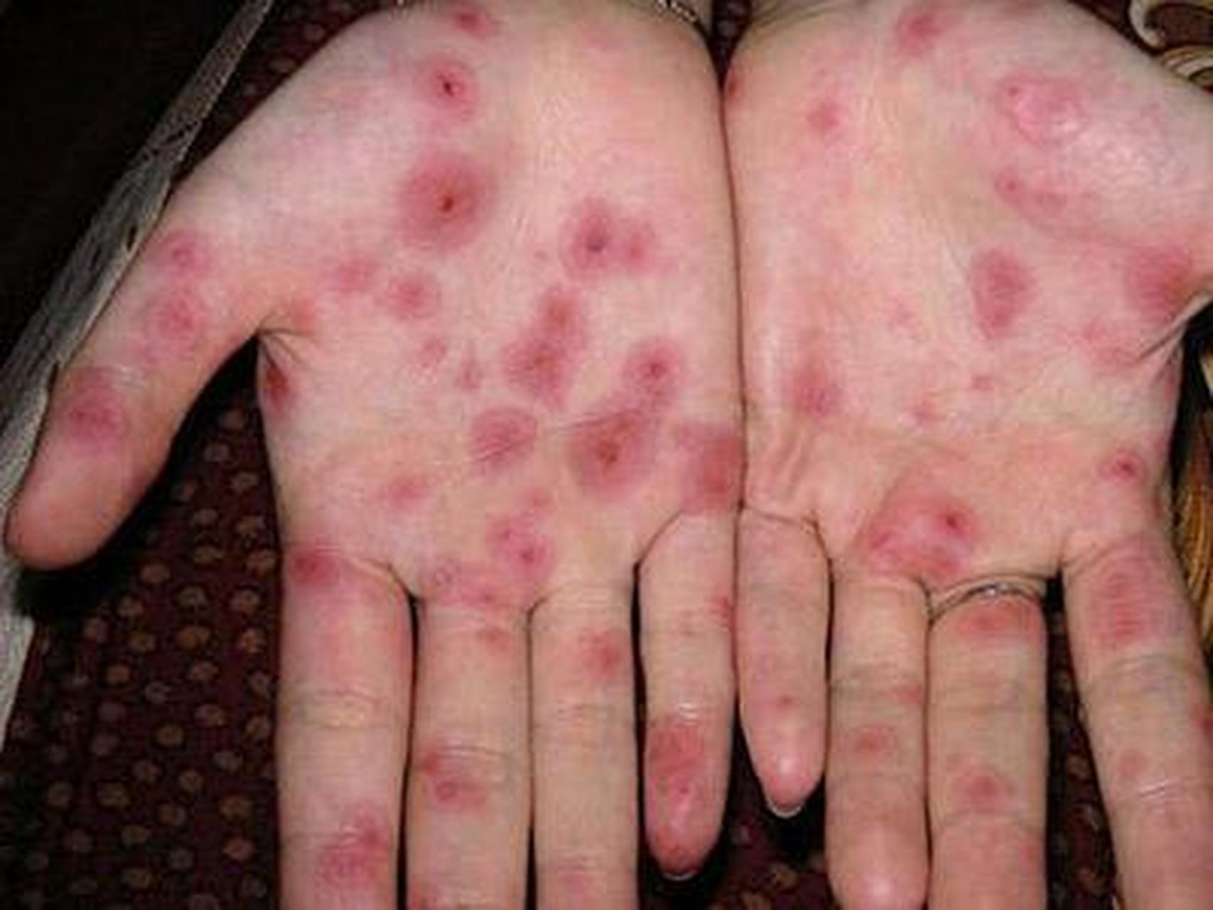 梅毒刚开始在欧洲肆虐的时候,哪个国家也不愿意承认是自己人把这脏病