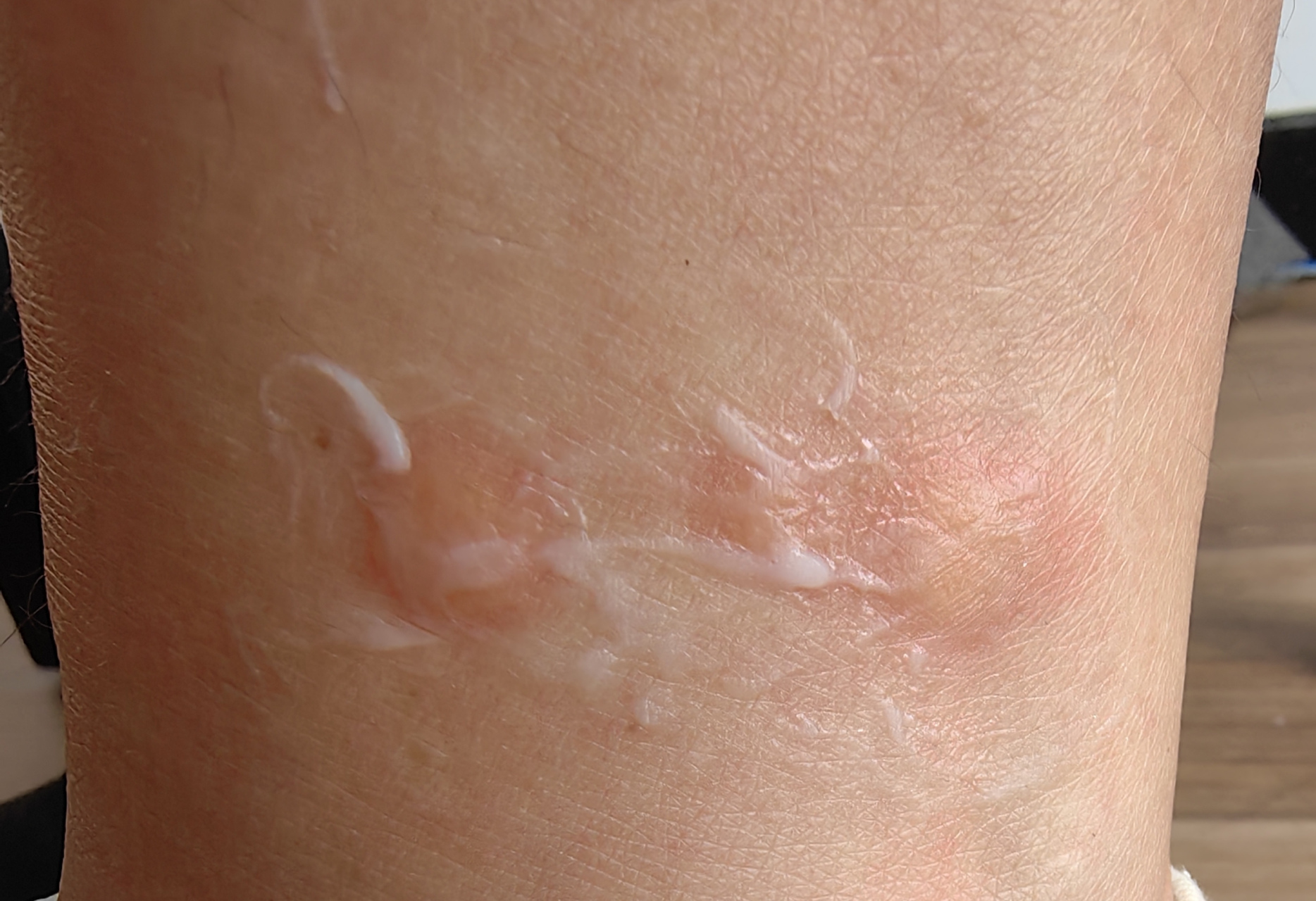 有谁懂被跳蚤咬的痛?