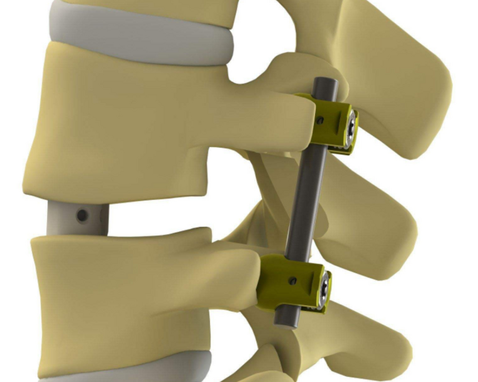 其实听到这种问题,还是挺替他担心的,如果打钉没有融合,将来肯定出
