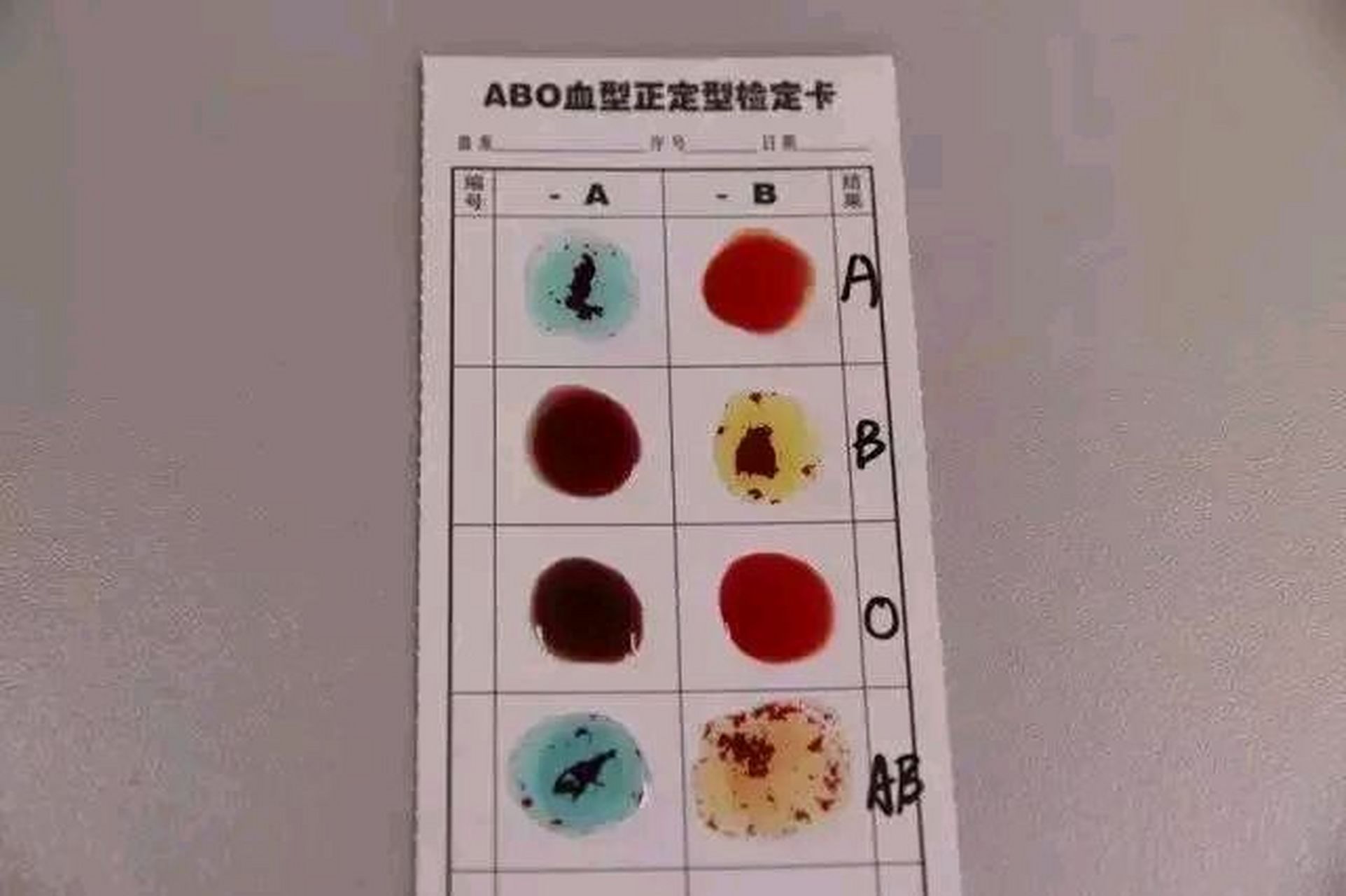 血型鉴定其实很简单,大家也可以在家里自己试一试 血型的鉴定方法有